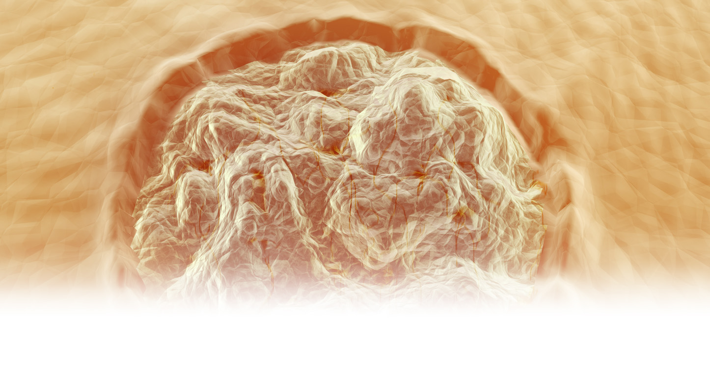 The Foot Health Practice is a specialist centre for veruca treatments